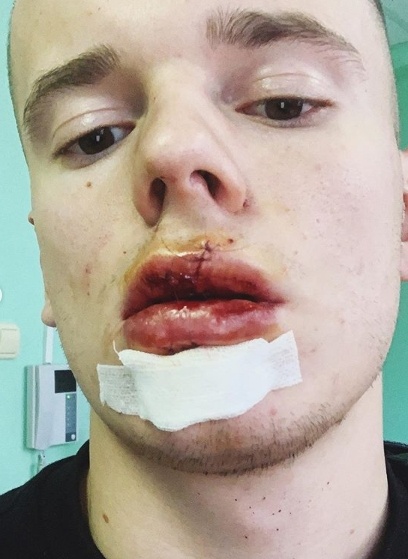 Арсений Шульгин, операция, губы(2019)|Фото: Instagram Арсений Шульгин