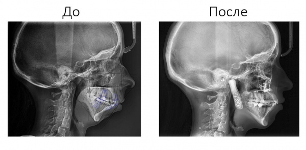 Челюсть пострадавшей из-за артрита 28-летней жительницы Московской области до и после операции(2024)|Фото Министерство здравоохранения Тюменской области