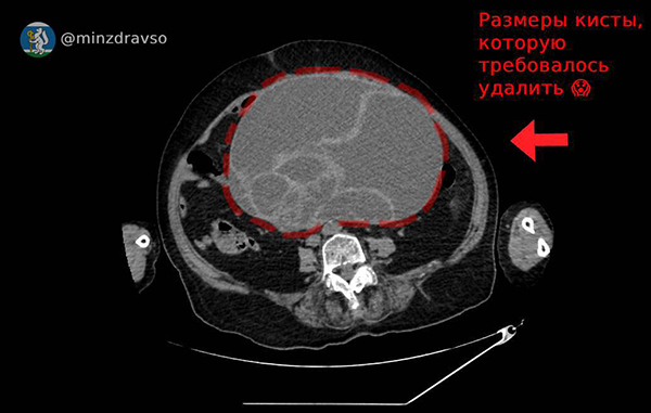 Размер 4,5-килограммовой кисты, удаленной у пациентки в Красноуфимской районной больнице(2025)|Фото: пресс-служба Минздрава Свердловской области