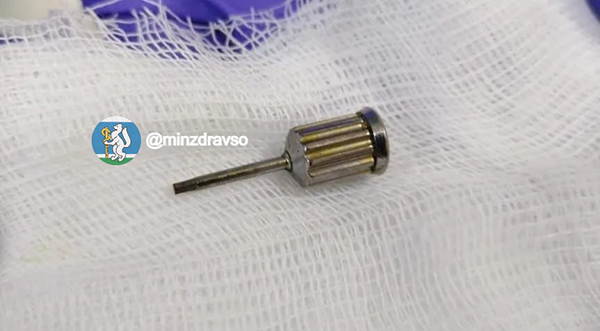 Стоматологическая отвертка, извлеченная из тела екатеринбурженки(2026)|Фото: пресс-служба Минздрава Свердловской области
